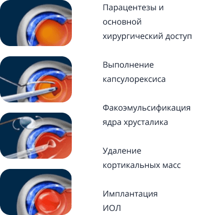Основные этапы факоэмульсификации катаракты