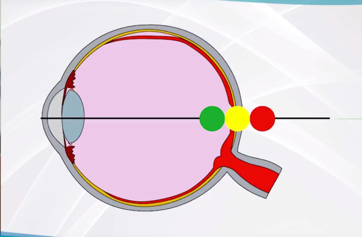 Подбор мягких контактных линз: оценка субъективной рефракции
