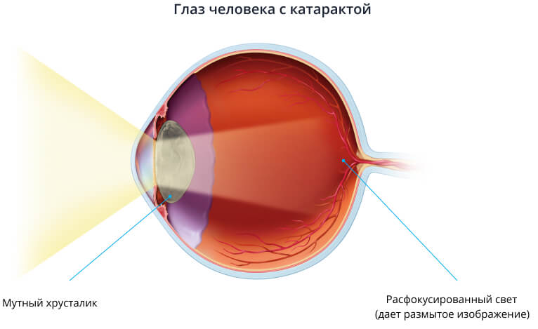 Глаз человека с катарактой