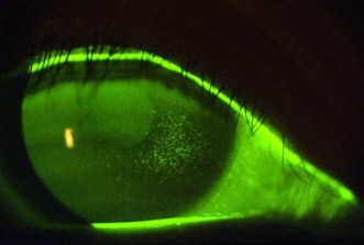 Катаракта синдром сухого глаза лечение