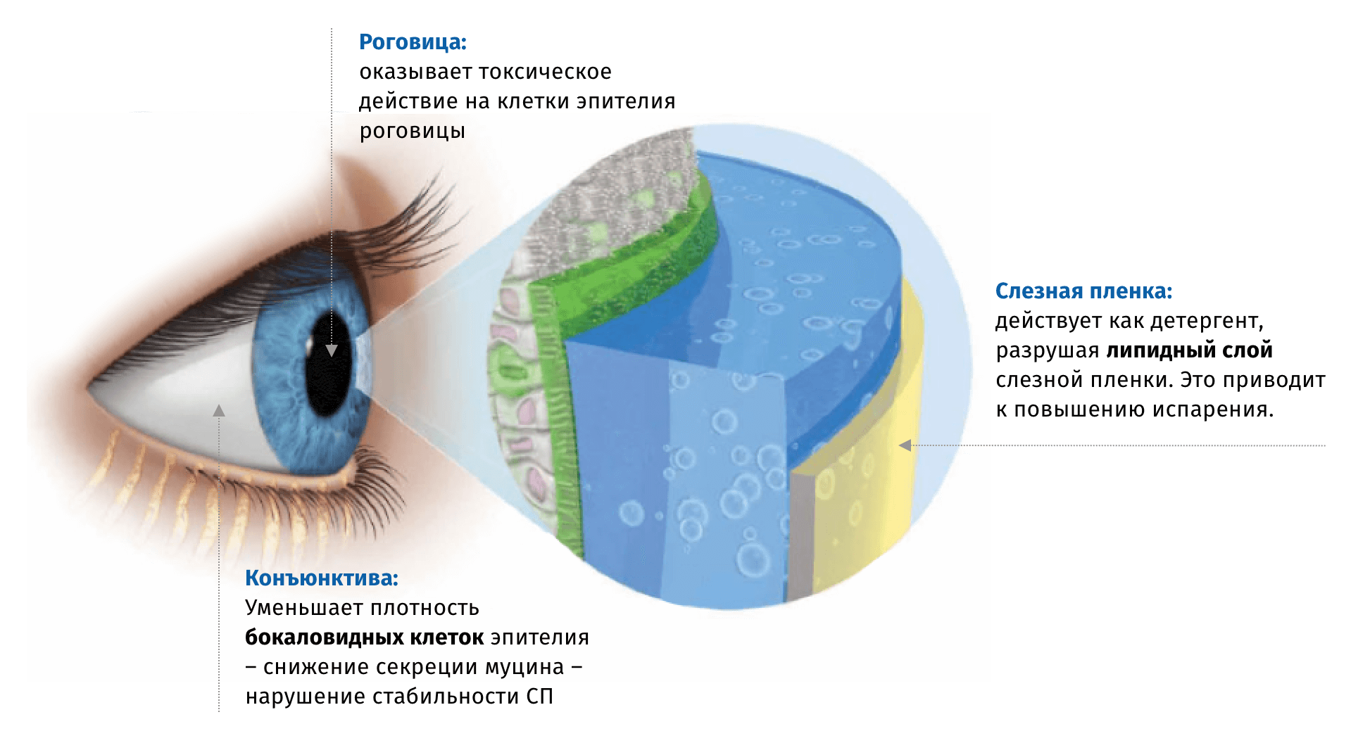 Сухой глаз и глаукома